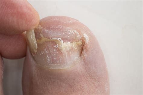 Infected Big Toe Stock Photo Image Of Peel Human Nasty 265540586