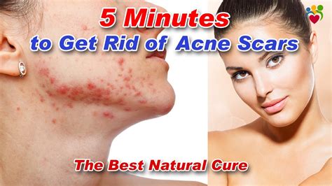 Get Rid Of Acne Scars Youtube