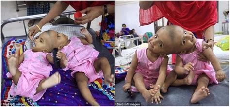 Conjoined Twins Set To Undergo Separation Surgery To Save Their Lives