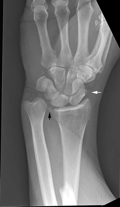 Monteggia And Galeazzi Fracture Dislocations Of The Forearm