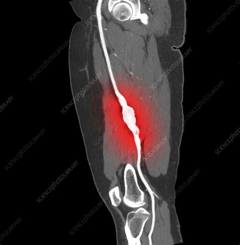 Femoral Aneurysm Ct Scan Stock Image F Science Photo Library