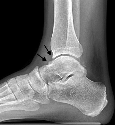 Imaging Manifestations Of Ankle Impingement Syndromes Radiologic Clinics