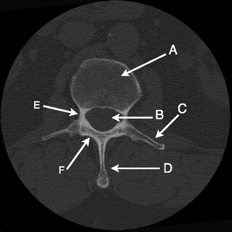 Axial Ct Image Of Lumbar Vertebra Using Bone Window Settings A