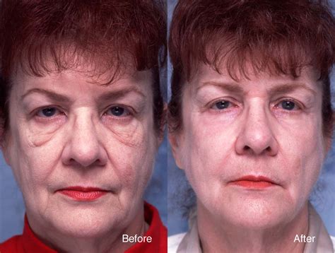 Chemical Peel Case Studies Beverly Hills Dermal Peel Studies Los Angeles