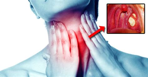 How To Get Rid Of Tonsillitis And Sore Throat In Only 4 Hours