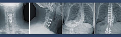 Pediatric Spina Bifida Neurosurgery