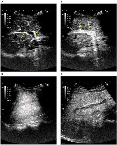 Transjugular Intrahepatic Portosystemic Shunt Ultrasound Evaluation