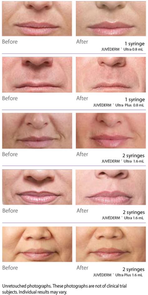 Juvederm Ultra Plus Before And After Lipstick