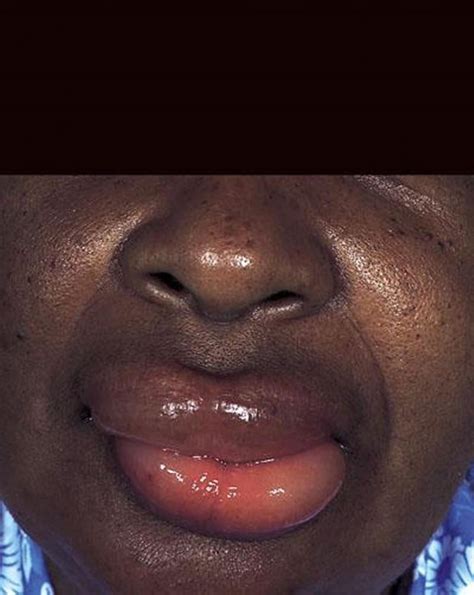 Swelling Of Lips Icd 10