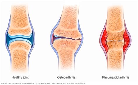 Rheumatoid Arthritis Symptoms And Causes Mayo Clinic