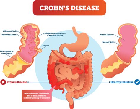 Crohn S Disease Explained Parkland Natural Health In London