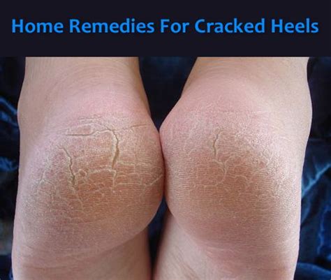 Home Remedies For Cracked Feet Homestead And Survival Home Remedies Remedies Home Medicine