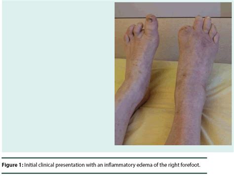 Forefoot Osteolysis Revealing A Charcot Osteoarthropathy