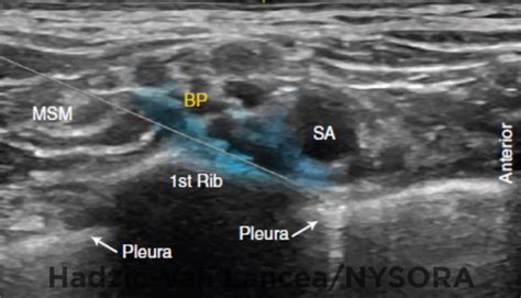 Ultrasound Guided Supraclavicular Brachial Plexus Block Nysora The