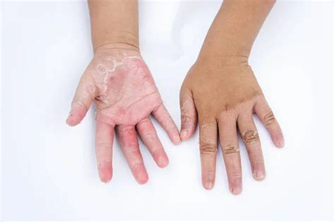 Manos Secas Cáscara Dermatitis De Contacto Infecciones Fúngicas