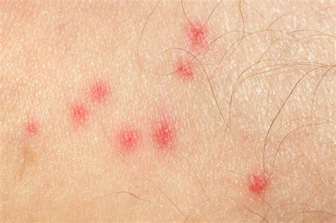 Identify The Cause Of Your Itchy Bug Bite