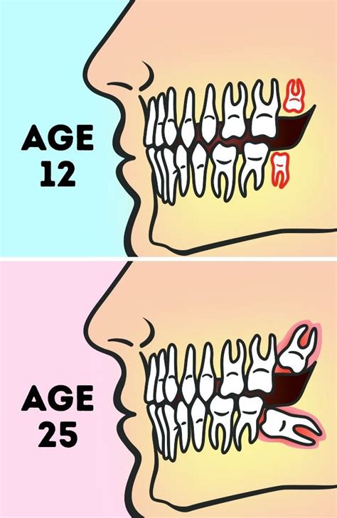 Do We Really Need To Remove Wisdom Teeth Wisdom Teeth Sensitive