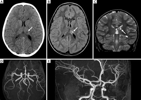 Head Ct Brain Mri And Mr Angiography Mra At Clinical Onset A