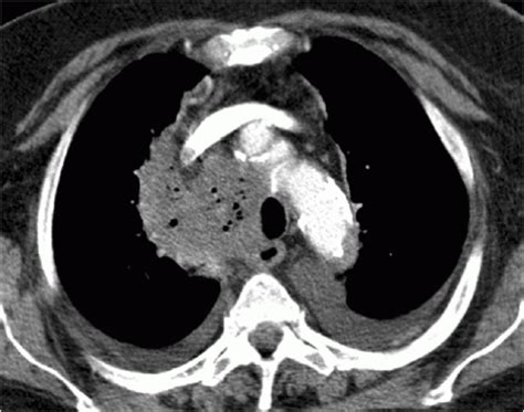 Mediastinal Diseases Radiology Key