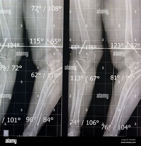 Plain X Ray Long Film Standing Position Showing Both Legs With