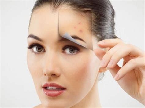10 Diy Home Remedies For Acne Laser Acne Treatment How To Remove