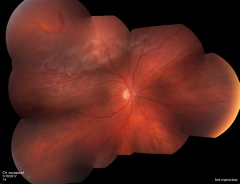 Macula Off Retinal Detachment With Horseshoe Tear Retina Image Bank