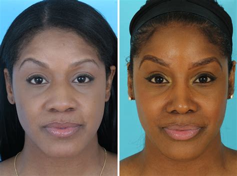 Reshape The Appearance Of The Nose By The Best Cosmetic Surgery News Room