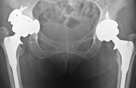 Hip Replacements Changes To Health Policy And Regulation Research