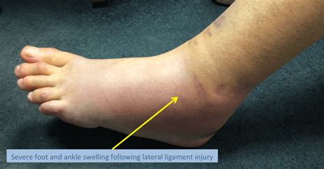 Ankle Lateral Ligament Injury Ankle Sprain Lfac