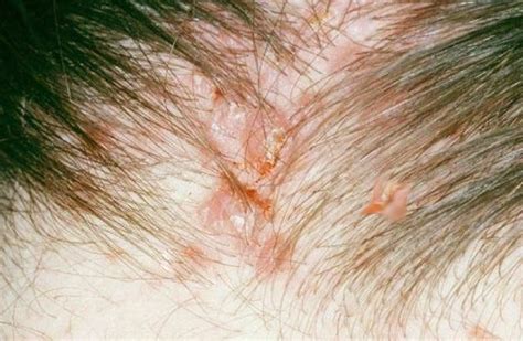 What Causes Pimples On The Scalp