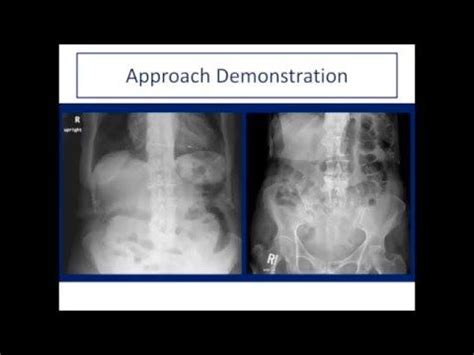 Abdominal Xray Introduction And Approach X Ray Fundamental Interactive