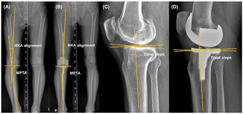 Medicina Free Full Text Accuracy Of The Tibial Component Alignment