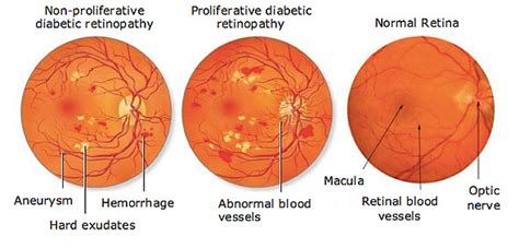 Diabetic Retinopathy Causes Symptoms Treatment Low Vision Aids