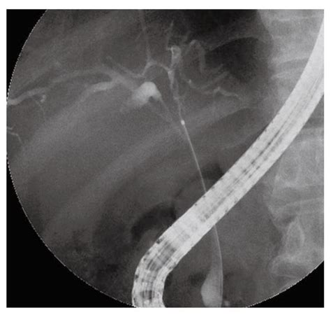 Anchor Wire Technique For Multiple Plastic Biliary Stents To Prevent