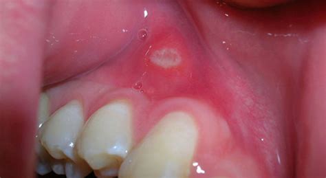 White Spot On Gums Causes Pictures Painful Above Tooth Under Tooth