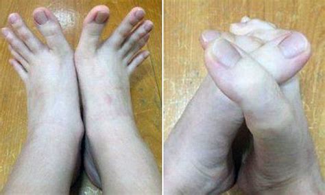 Fingers Or Toes Woman Stuns Internet After Posting Pictures Of Her