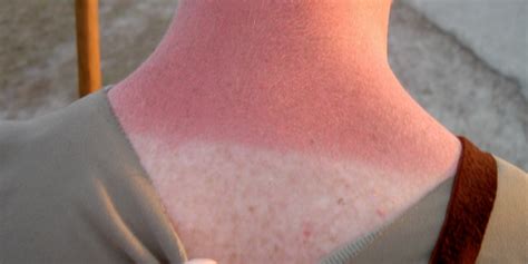 A Dermatologist Explains The Best Way To Relieve And Heal Sunburn