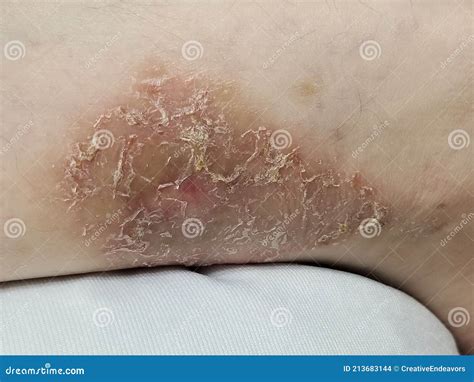 Pyoderma Gangrenosum On Leg Of Patient With Ulcerative Colitis Stock