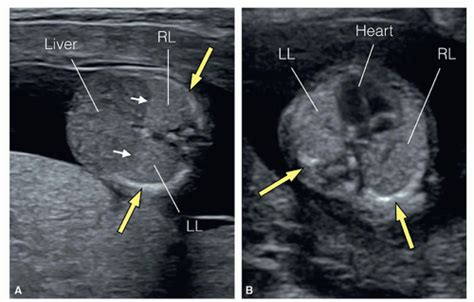 The Fetal Chest Radiology Key