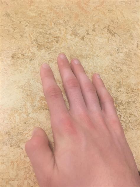 My right thumb is permanently bent; I can’t extend it : r/mildlyinteresting