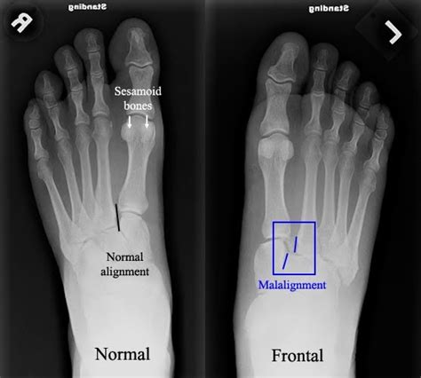 Metatarsal Stress Fracture Fracture Treatment