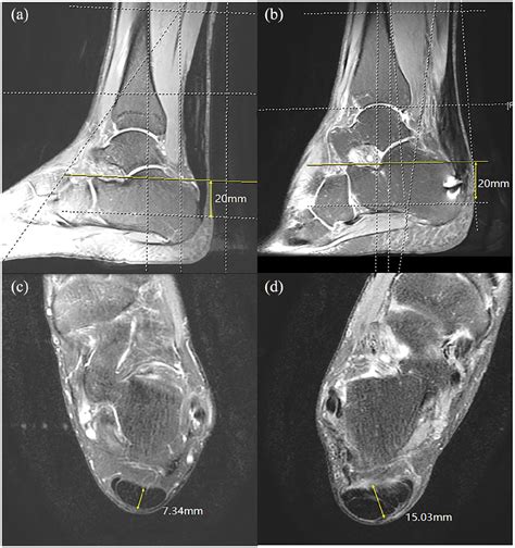 Calcaneoplasty Coupled With An Insertional Achilles Tendon Reattachment