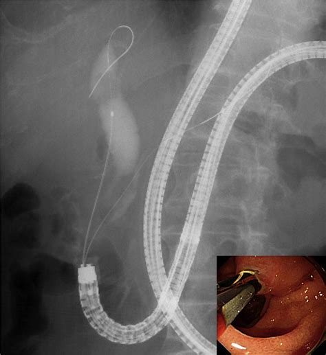 Balloon Enteroscopyassisted Ercp In Patients With Roux En Y