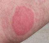 Treatment For Bed Bugs Rash Images