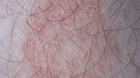 Hautausschlag 22 häufige Hautausschläge Bilder Ursachen und Behandlung