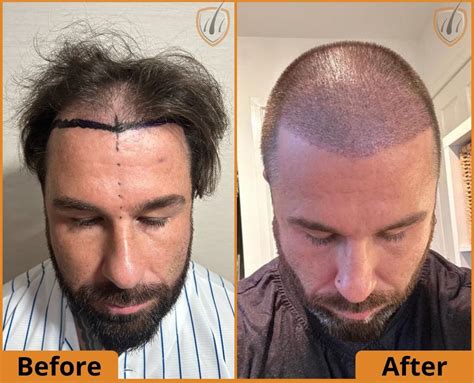 What To Expect 10 Days After The Hair Transplant Surgery