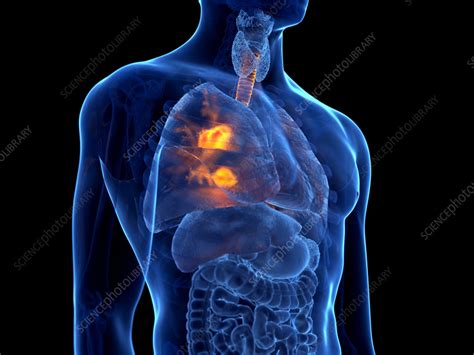 Lung Cancer Illustration Stock Image F0349911 Science Photo Library