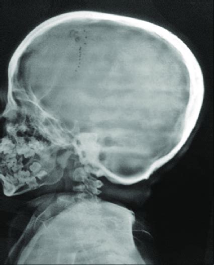 Skull Radiographs Showing Thickened Calvarium Download Scientific Diagram