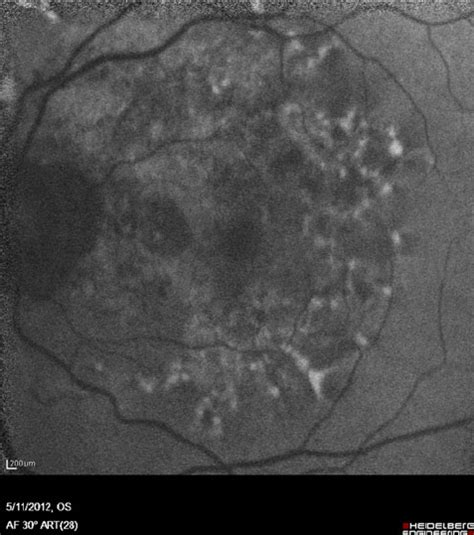 Angioid Streaks Originating From The Optic Disk Radiating Outwards