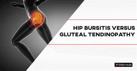 Hip Bursitis Versus Gluteal Tendinopathy